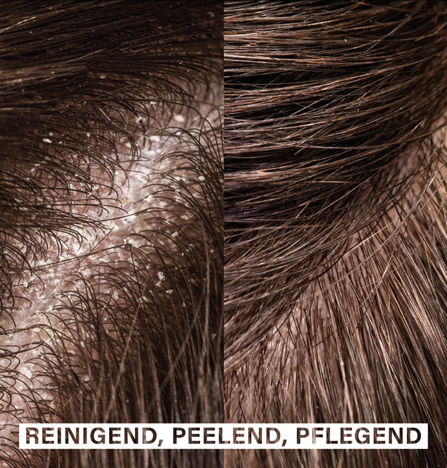 Exfoliating Hair Brush | for Healthy Scalp & Anti-Dandruff
