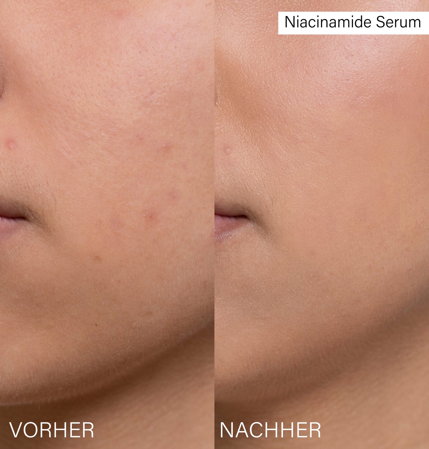 Niacinamide Serum | Pore-Refining Concentrate