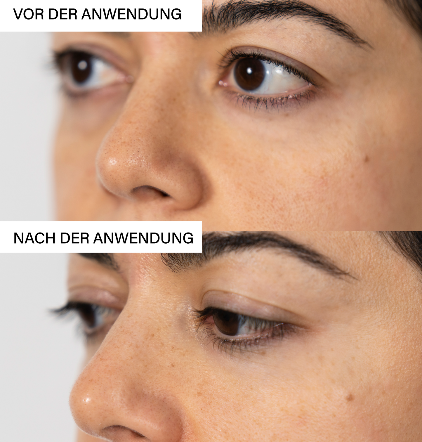 Skin Exfoliating Peeling | Pore-Refining Treatment