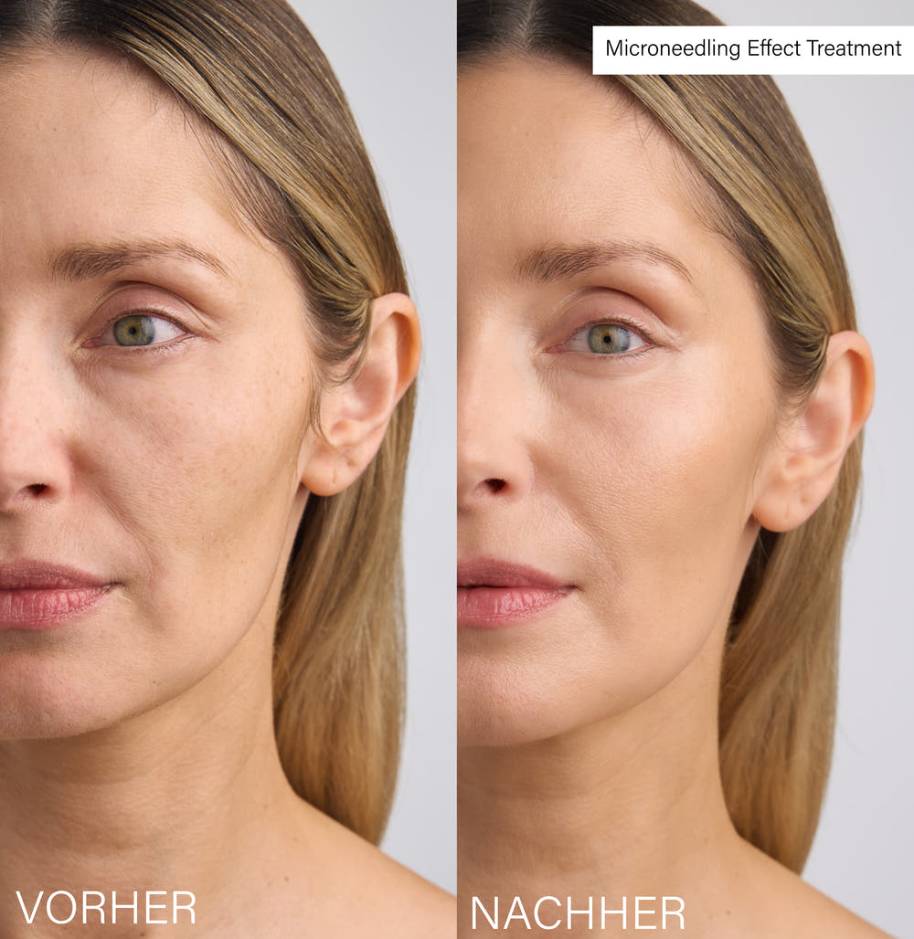 Microneedling Effect Treatment